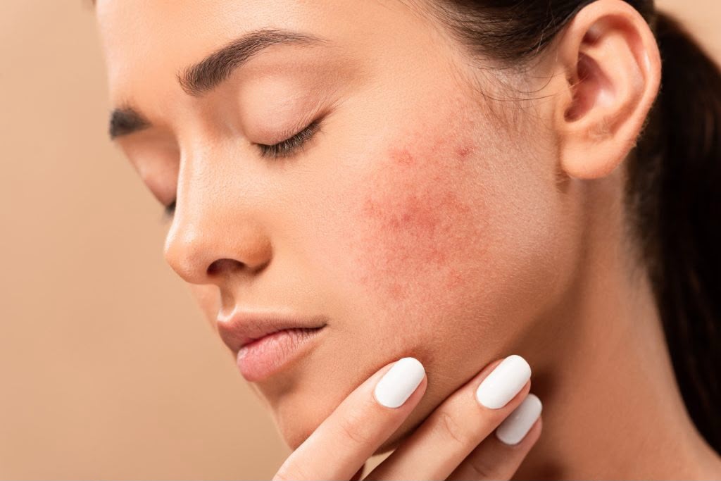 Acne & Acne Scar Treatment - Image 2